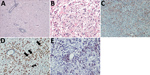 Thumbnail of Brain inflammation in patients with fatal variegated squirrel bornavirus 1 encephalitis. A) Brain section showing mononuclear cell infiltration and tissue edema. Hematoxylin and eosin stain; original magnification ×100. B) Depiction of glial cell activation in a brain biopsy sample of malacia. Astrocytes appear bizarre and enlarged. Hematoxylin and eosin stain; original magnification ×400. C) Demonstration of glial fibrillary acidic protein (GFAP). Immunoperoxidase stain with hemato