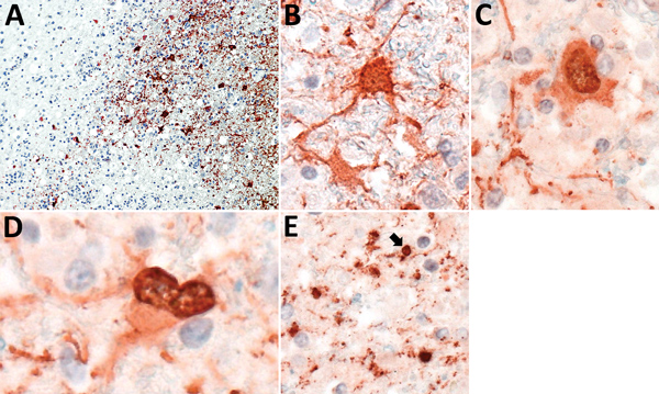 Presence of variegated squirrel bornavirus 1 (VSBV-1) antigen in neurons, astrocytes, and oligodendrocytes. A) Widespread presence of VSBV-1 antigen in brain tissue. Endothelial cells show no viral antigen. Immunoperoxidase stain with hematoxylin counterstain; original magnification ×200. B, C) Demonstration of VSBV-1 antigen in neurons. Immunoperoxidase stain with hematoxylin counterstain; original magnification ×600. D) VSBV-1 antigen in an astrocyte. Immunoperoxidase stain with hematoxylin co