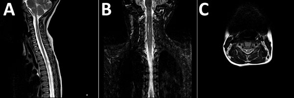 Magnetic resonance images of brain of a 3-year-old girl with enterovirus encephalomyelitis (paresis of the right upper limb). A) Image of the cervical spine: sagittal T2 sequence; B) short tau inversion recovery (STIR) coronal sequence; C) T2 axial sequence. Hyperintense filiform lesions in the anterolateral regions of the spinal cord (C3–C5), predominantly right, are suggestive of myelitis.