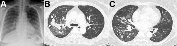 Analysis of 55-year-old immunocompetent woman with human metapneumovirus pneumonia, South Korea. A) Initial chest radiograph showing ill-defined patchy and nodular ground-glass opacities in the right lung and left lower lung zone. B, C) Chest computed tomography showing irregular nodular consolidation (arrows in panel B) and multiple ill-defined centrilobular nodular opacities (arrowheads in panel C) with mild bronchial wall thickening. Five days later, the lesions had resolved completely.