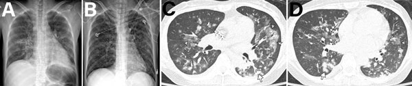Analysis of 38-year-old woman in South Korea who underwent liver transplantation 2 months earlier, followed by immunosuppressant therapy, who visited the emergency department because of dyspnea, chills, and fever. A) Initial chest radiograph showing bilateral peribronchial infiltration in the central areas of both lungs and minimal pleural effusion. B) Five days later, the patient was admitted to the intensive care unit and underwent intubation because of progressive dyspnea. Radiograph showed e