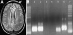Thumbnail of Imaging and PCR results for a 28-year-old man with Oropouche virus infection, southeastern Brazil. A) Cerebral computed tomography showing a cortical edema on the left frontal lobe (white arrow). B) Agarose gel of reverse transcription PCR products of Oropouche virus S fraction. Lane 1, patient’s serum sample; lane 2, patient’s cerebrospinal fluid; lane 3, patient’s leukocyte supernatant; lane 4, negative control; lane 5, internal control; lane 6, positive control.