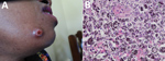 Thumbnail of Imaging from investigation of emergomycosis in a 38-year-old woman from Rwanda with HIV infection living in Uganda. A) Skin lesion on face. B) Histopathology of skin biopsy specimen (Grocott stain) showing multiple budding yeast cells (2–3 µm), mostly in clusters. Scale bar indicates 5 µm.