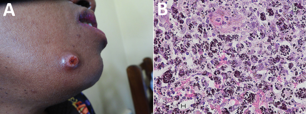 Imaging from investigation of emergomycosis in a 38-year-old woman from Rwanda with HIV infection living in Uganda. A) Skin lesion on face. B) Histopathology of skin biopsy specimen (Grocott stain) showing multiple budding yeast cells (2–3 µm), mostly in clusters. Scale bar indicates 5 µm.