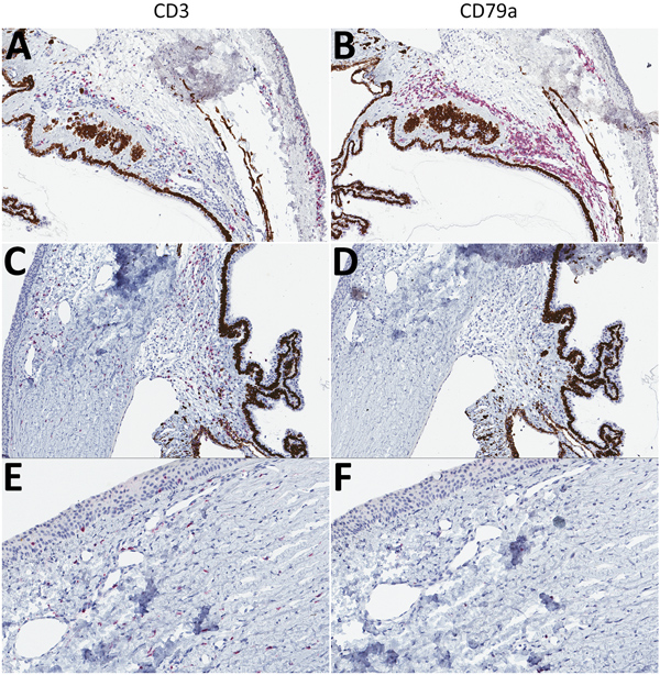 T-lymphocyte inflammation predominant in the eyes of animals that died of Lassa virus (LASV) infection &gt;17 days postinfection in study of LASV targeting of anterior uvea and endothelium of cornea and conjunctiva in eye. CD3+ (left) and CD79a+ (right) lymphocyte antigens targeted by immunohistochemical (IHC) analysis are stained red. A) Inflamed filtration angle and sclera highlighting CD3+ T-lymphocytes. Original magnification ×10. B) Inflamed filtration angle and sclera highlighting the pred