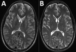 Thumbnail of Magnetic resonance imaging (MRI) of the brain of a patient with encephalitis caused by Powassan virus, Massachusetts, USA, 2017. A) Initial brain MRI showing high T2 signal abnormality in the bilateral caudate and putamen. B) Noticeable improvement on repeat brain MRI 2 weeks later.