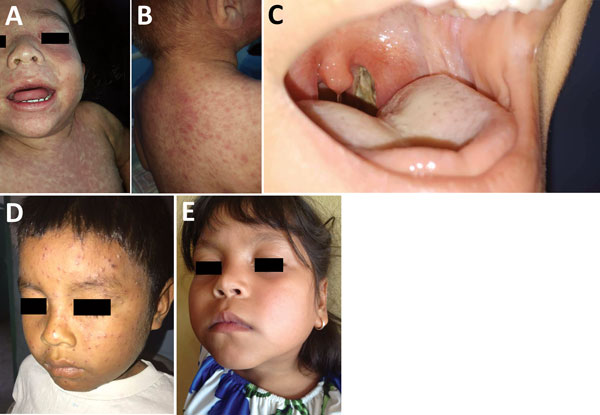 Clinical features observed in children infected with vaccine-preventable diseases, Venezuela, 2017–2018. A, B) Classic morbilliform measles rash in a Creole infant from Caracas. Note the pronounced erythematous confluent macules and patches on face and subsequently a cephalocaudal spread onto the trunk and extremities. C) Thick, gray membrane covering the pharynx and posterior aspects of tonsils in a case of diphtheria. D) A Pemón Amerindian child with a classical varicella rash exhibiting vario