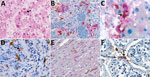 Thumbnail of Immunohistochemical stains of tissue from patients with fatal cases of Ebola virus (EBOV) disease showing EBOV (red) and CD163 (brown) antigens. A) Hematoxylin and eosin stain of liver showing hepatocellular necrosis with intracytoplasmic eosinophilic inclusions (arrow). B) EBOV antigens in hepatocytes and CD163 antigens in macrophages. C) High magnification image of double immunohistochemical staining of liver tissue showing colocalization of EBOV and CD163 antigens in macrophage (