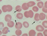 Thumbnail of Wright stain of peripheral blood demonstrating extracellular spirochetes (arrows) confirming tickborne relapsing fever in a 64-year-old woman, Tucson, Arizona, USA, October 2016.