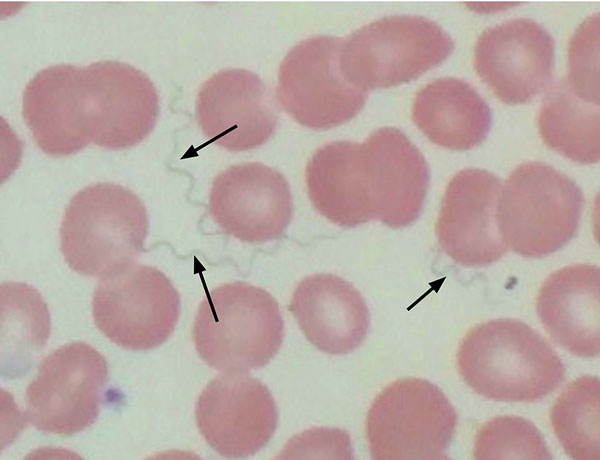 Wright stain of peripheral blood demonstrating extracellular spirochetes (arrows) confirming tickborne relapsing fever in a 64-year-old woman, Tucson, Arizona, USA, October 2016.