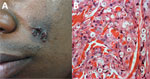 Thumbnail of Lobomycosis in a 40-year-old soldier (case-patient 4), Colombia. A) Phototype V lesion on the left cheek with papules that became confluent and formed a lobulated plaque with a smooth and shiny surface. B) Periodic acid–Schiff staining of a biopsy specimen from the lesion shows multiple yeasts of uniform size, and thick walls are seen inside phagocytoses (original magnification ×40).