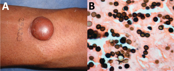 Lobomycosis in a 32-year-old soldier (case-patient 5), Colombia. A) Solitary yeast erythematous nodule (4 cm × 3.5 cm) resembling a keloid scar with a smooth and shiny surface on the right arm. B) Grocott staining of a biopsy specimen from the lesion shows typical chains (original magnification ×40).