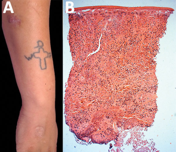 Lobomycosis in a 24-year-old soldier (case-patient 6), Colombia. A) Erythematous-violaceous infiltrated plaque (4 cm x 3 cm) with a shiny surface on the right forearm and typical leishmaniasis cicatricial plaque on the same limb. B) Testing of biopsy sample from the lesion. Epidermis shows no hyperplasia or ulceration, but dermis shows diffuse inflammation rich in vacuolated macrophages; Grocott-Gomori staining shows yeast cells (original magnification ×2.5).