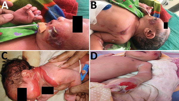 Newborn infants with cutaneous lesions mostly on face (A), left upper chest (B), neck (C), and hand (D), Assam Medical College &amp; Hospital, Dibrugarh, India, 2018. This outbreak was later determined to have been caused by Bacillus cereus.