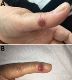 Thumbnail of Nodules on the A) left thumb and B) left little finger of a 65-year-old woman infected with orf virus during Aïd-el-Fitr festival, France, 2017.