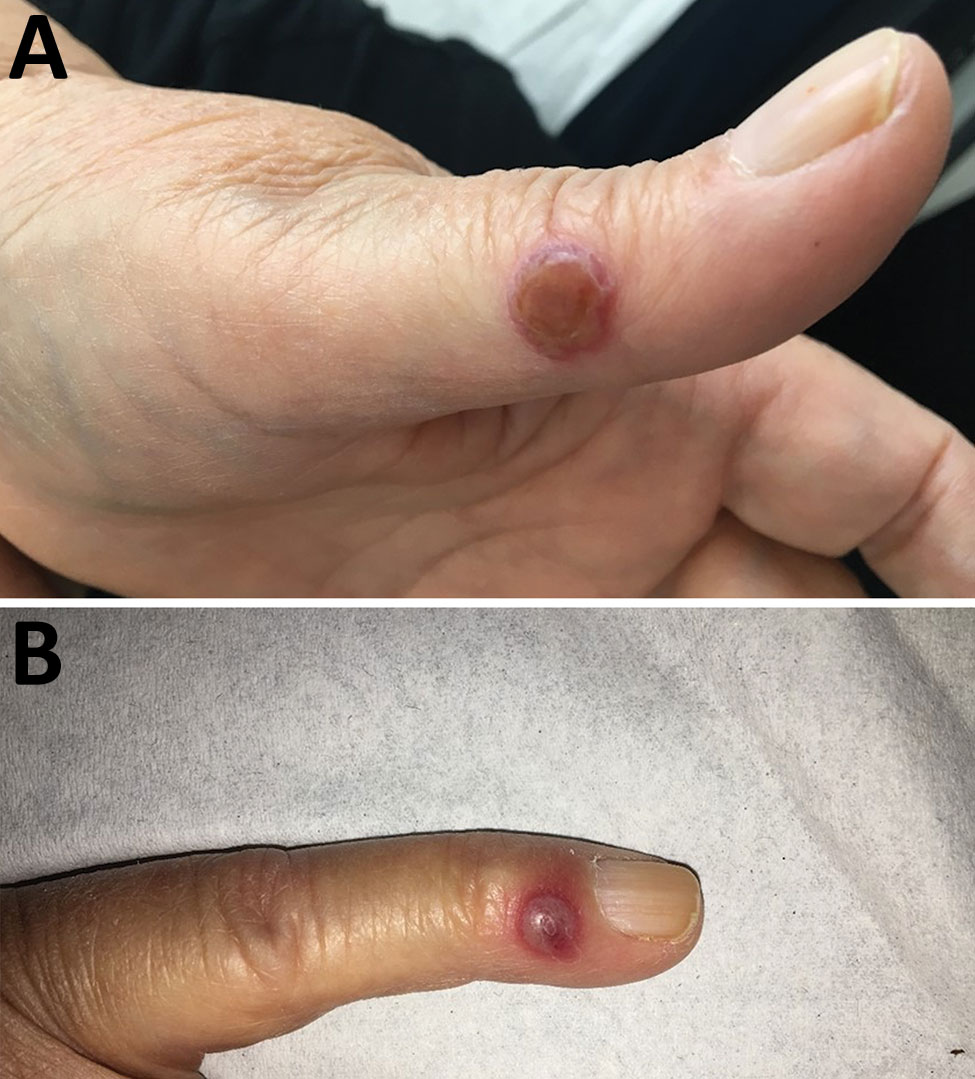 Nodules on the A) left thumb and B) left little finger of a 65-year-old woman infected with orf virus during Aïd-el-Fitr festival, France, 2017.