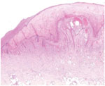 Thumbnail of Histopathologic analysis of a skin biopsy specimen from a 65-year-old woman infected with orf virus during Aïd-el-Fitr festival, France, 2017. The specimen shows epidermal hyperplasia with acantolysis and papillomatosis, extensive hyperkeratosis, spongiform degeneration and vacuolated cells, and inflammatory infiltration in the dermis, predominantly by histiocytes and lymphocytes. Hematoxylin and eosin stain, original magnification x100.