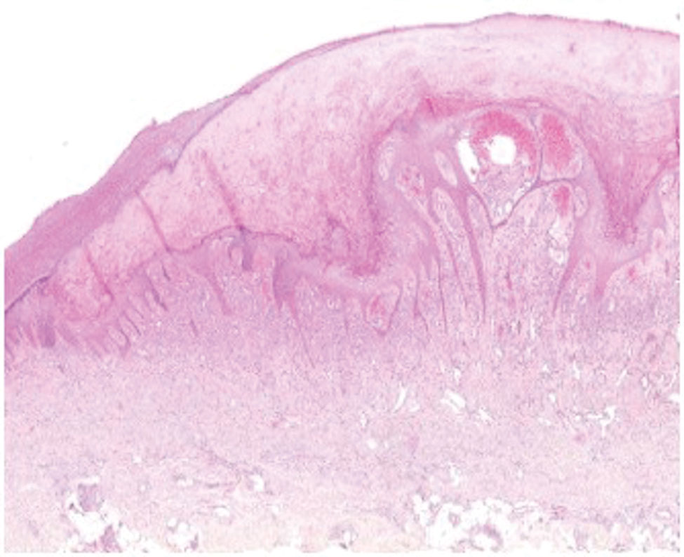 Histopathologic analysis of a skin biopsy specimen from a 65-year-old woman infected with orf virus during Aïd-el-Fitr festival, France, 2017. The specimen shows epidermal hyperplasia with acantolysis and papillomatosis, extensive hyperkeratosis, spongiform degeneration and vacuolated cells, and inflammatory infiltration in the dermis, predominantly by histiocytes and lymphocytes. Hematoxylin and eosin stain, original magnification x100.