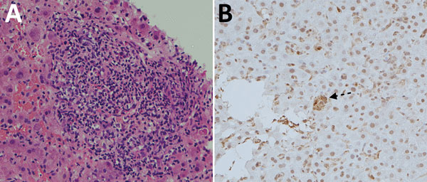 Histology of tissue from liver graft of hepatitis E virus case-patient 1, a 66-year-old man, on posttransplantion day 122. A) Hematoxylin and eosin staining showing moderate (grade 2) inflammation. B) Immunohistochemical staining (using hepatitis E virus monoclonal antibody); arrow indicates small groups of hepatocytes with positive cytoplasmic signals.