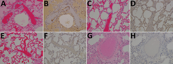 Results of testing for Nipah virus (NiV) in lung tissue from representative vaccinated African green monkeys (Chlorocebus aethiops). A, C, E, G) Hematoxylin and eosin staining; B, D, F, H) immunohistochemistry of tissues labeled with NiV N protein–specific polyclonal rabbit antibody. In stained tissue from the control animal (A), diffuse thickening of alveolar septae by moderate numbers of lymphocytes, plasma cells, polymerized fibrin, and edema fluid within the alveolar spaces were found; stain