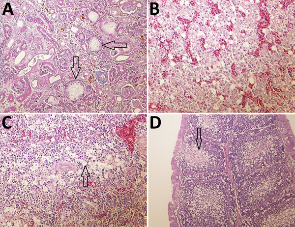 Histologic appearance of lesions in tissues from chickens experimentally infected with a novel orthobunyavirus (Kedah fatal kidney syndrome virus) isolated from broiler chickens with severe kidney disease, Malaysia, 2014–2017. A) Kidney, showing urate deposits in the dilated Bowman’s capsule (arrows) and degeneration and dilatation of proximal convoluted tubules. Trichcrome stain; original magnification ×200. B) Liver, showing vacuolar degeneration of hepatocytes and disorganization of lobular s