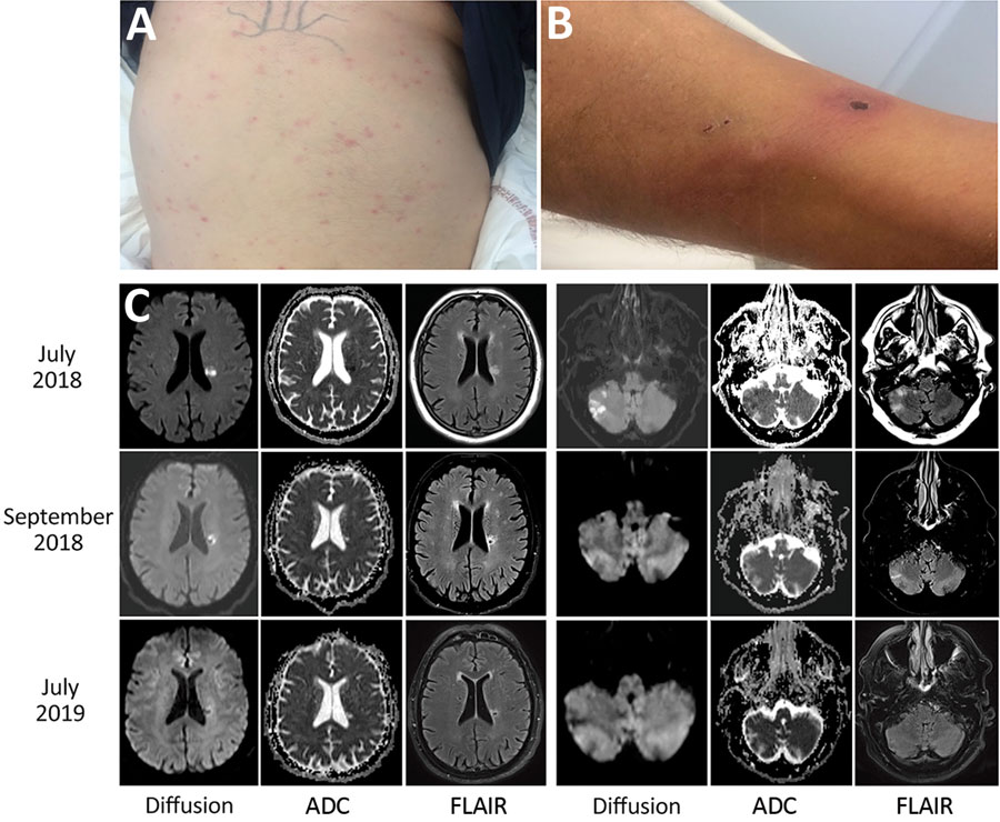 Clinical manifestations and cerebral magnetic resonance imaging of a 66-year-old man with Rickettsia sibirica mongolitimonae–associated encephalitis, southern France, 2018. A) Maculopapular rash. B) Black eschar and rope-like lymphangitis on the right leg. C) Magnetic resonance imaging with diffusion (B1000), ADC, and FLAIR. In July 2018, cytotoxic lesions were observed intra-axially and in the white matter of right cerebellar hemispheres with FLAIR hypersignal and with low ADC signal. In Septem