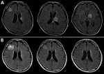 Thumbnail of Serial brain magnetic resonance imaging results for a 57-year-old man with Toxoplasma gondii encephalitis, Tokyo, Japan. A) All 3 lesions were evident when the patient first sought care. B) Chronologic changes are shown of the lesion in the right frontal lobe in response to antitoxoplasmic therapy after 1 (left), 3 (center), and 12 (right) months.