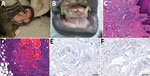 Thumbnail of Disease manifestations in mantled guereza with Kaposi sarcoma. A) Oligofocal flattened masses on the inner aspects of the lower lip. B) Multinodular fissured masses at the gingival margin. C) Fibrovascular stroma in the subepithelial propria of the lower lip with spindle cell proliferations delineating narrow vascular clefts and containing lymphoplasmacytic inflammatory cell infiltrates, hematoxylin and eosin stained; scale bar indicates 200 µm. D) Spindle cell proliferation with ca