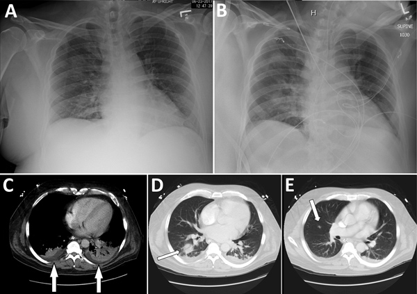 Radiographs (A, B) and computed tomography (C–E) images of chest of organ donor with Francisella tularensis infection, United States, 2017. Images were taken after brain death. A) Anteroposterior view with patient in upright position, taken on day of admission; B) anteroposterior view with patient in supine position, taken on hospital day 10. C) Small bibasilar pleural effusions with adjacent subsegmental atelectasis versus pneumonia in the lower lobes (arrows); D) 3-cm round focus of pneumonia 