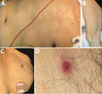 Thumbnail of Patient with Rickettsia japonica infection after being bitten by a land leech, Japan. A, B) Erythematous macular rash on the patient’s torso (A) and extremities (B); C, D) eschar on the lower abdomen showing an atypical appearance with a relatively well-demarcated boundary of erythema with a tiny scab.