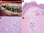 Thumbnail of Macroscopic and microscopic lesions of peste des petits ruminants virus–infected saiga, Mongolia, 2016–2017. A) Extensive necrotic surface plaque with multifocal ulceration lining the oral mucosa along the gingival margin of the molar teeth. B) Erosion and necrosis of the superficial oral mucosa with multifocal epithelial syncytia (inset, arrows). Original magnification ×200; inset ×1,000. C) Multifocal hepatocellular necrosis (upper and lower left, upper right) with dissolution of 