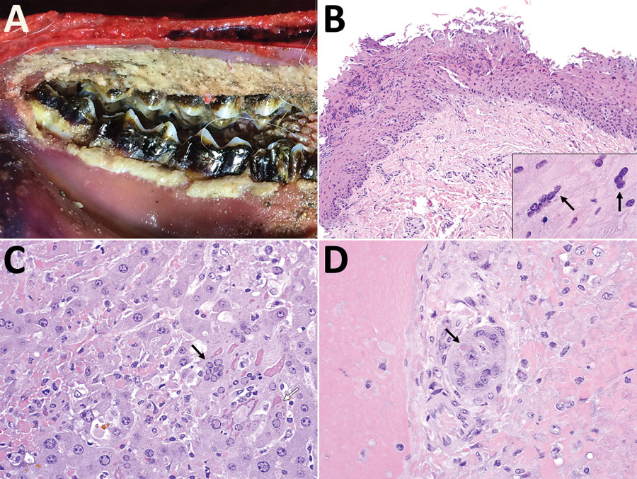 Macroscopic and microscopic lesions of peste des petits ruminants virus–infected saiga, Mongolia, 2016–2017. A) Extensive necrotic surface plaque with multifocal ulceration lining the oral mucosa along the gingival margin of the molar teeth. B) Erosion and necrosis of the superficial oral mucosa with multifocal epithelial syncytia (inset, arrows). Original magnification ×200; inset ×1,000. C) Multifocal hepatocellular necrosis (upper and lower left, upper right) with dissolution of hepatic cord 