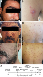 Thumbnail of Dermal manifestations of monkeypox on patient in Israel, 2018. Maculopapular rash was apparent on the face (A) and body on the day of hospital admission. A lesion on the left proximal extremity (B) was suspected to be a rickettsial eschar. After 3 days, the rash changed into vesicles and pustules on the face (C) and body (D). Skin resolution was apparent 13 days after admission; pustules and vesicles crusted and were shed (E, F). G) Timeline of disease progression.