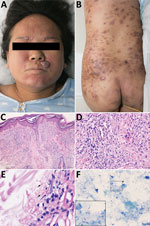 Thumbnail of Clinical features of Mycobacterium leprae infection in pregnant woman and pathologic characteristics of a biopsy and placenta samples, China, December 2017. A, B) multiple brown papules and firm nodules on the woman’s trunk and face and ichththyosis presentation on the anterior tibia. C, D) Testing of biopsy sample from the face demonstrates subepidermal clear zone, nodular proliferation of spindle shaped histiocytes in the dermis. Hematoxylin and eosin stain; original magnification