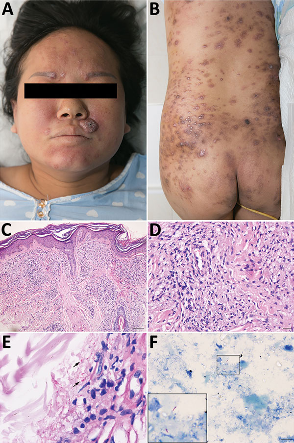 Clinical features of Mycobacterium leprae infection in pregnant woman and pathologic characteristics of a biopsy and placenta samples, China, December 2017. A, B) multiple brown papules and firm nodules on the woman’s trunk and face and ichththyosis presentation on the anterior tibia. C, D) Testing of biopsy sample from the face demonstrates subepidermal clear zone, nodular proliferation of spindle shaped histiocytes in the dermis. Hematoxylin and eosin stain; original magnification ×10 (C) and 
