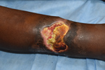 Thumbnail of Typical Buruli ulcer lesion on the arm of a patient from Ghana. Central necrosis, yellowish-white slough, and undermined edges surround the wound. Photo courtesy of T.S. van der Werf.