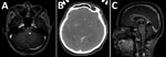 Thumbnail of Imaging of brain and spine of 3 patients infected with Mycobacterium haemophilum who had involvement of the central nervous system, Bangkok, Thailand. A) Patient 1, axial T1-weighted magnetic resonance imaging scan with gadolinium showing enhanced nodule at left dorsal pons. B) Patient 2, axial contrast-enhanced computed tomography scan showing hypodensity lesions in both thalami and nodular enhancement at the bilateral basal ganglia. C) Patient 3, sagittal T1-weighted magnetic reso