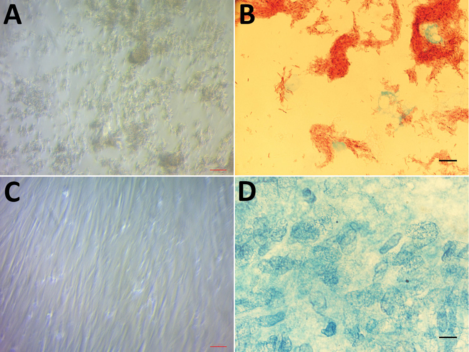 Light microscopic examination of human embryonic lung cells inoculated for 28 days from a clinical sample from a 47-year-old man with Pott’s disease and systemic tuberculosis, France. A) Cytopathic effect consisting of cell lysis caused by growing Mycobaterium tuberculosis. Original magnification ×200. B) M. tuberculosis mycobacteria observed after Ziehl-Neelsen staining. Original magnification ×1,000, by oil immersion. C) Absence of any cytopathic effect in negative control cell culture. Origin