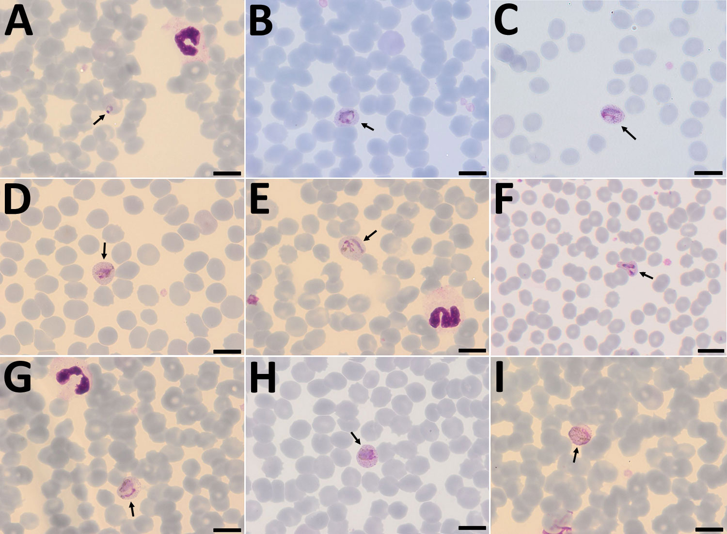 Plasmodium cynomolgi parasites in a Giemsa-stained thin smears of blood from a traveler returning from Southeast Asia to Denmark. Overall, few parasites were visible in the thin film, and no schizonts were visible at all. A) Young trophozoite. The cytoplasm is ring shaped, and the nucleus is spherical. The erythrocyte is not enlarged, and neither Schüffner’s dots nor pigment are visible. B) Growing trophozoite. The young parasite is ring shaped and takes up more than half of the diameter of the 