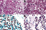 Thumbnail of Histologic evidence of amniotic fluid aspiration, bronchopneumonia, and intraalveolar gram-negative coccobacilli in the lung of a stillborn infant, Mozambique. A) Hematoxylin and eosin stain of lung tissue showing acute inflammation within alveoli (bronchopneumonia, upper arrow) and moderate numbers of aspirated squames (lower arrow), consistent with intrauterine fetal distress and associated aspiration of amniotic fluid. Original magnification ×20. B) Higher magnification of panel 