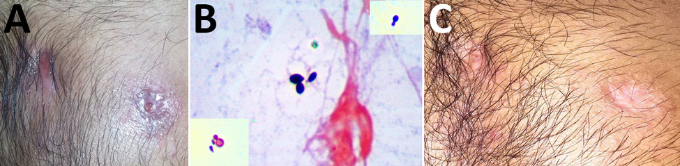 Patient with blastomycosis, India, 2014. A) Photograph of chest showing actively discharging sinuses before treatment with antifungal medication. B) Histopathology slide of Gram-stained pus discharge, showing broad-based budding yeast cells. The insets show Gram staining of the same organism, with narrow and broad-based budding in different fields. Original magnification ×100. C) Photograph of chest showing closed sinuses and disappearance of sinus line after treatment with antifungal medication