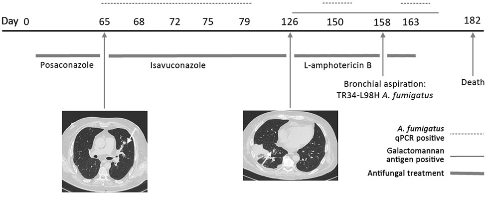 Evolution of fungal biomarkers, computed tomography chest scans, and antifungal treatments for immunocompromised patient 1 with invasive Aspergillus fumigatus infection, France, 2018. Arrows indicate lesions. qPCR, quantitative PCR.