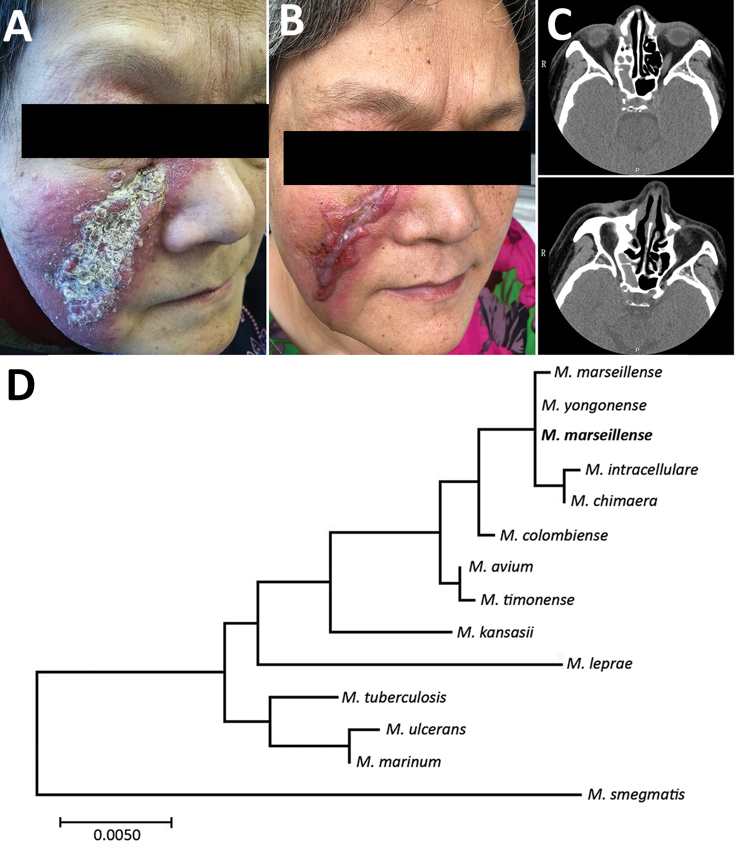 Skin lesions and computer tomography scans of woman with Mycobacterium marseillense skin infection, China, 2018, and genomic analysis of isolate. A, B) Facial skin lesion of woman with M. marseillense infection before and after treatment. Infiltrated erythematous plaque with yellowish scales and crusts (A) resolved to a scar after clearance of infection (B). C) Computed tomography imaging before treatment (top) shows heterogeneous hypersignal in right ethmoid sinus and after treatment (bottom) s