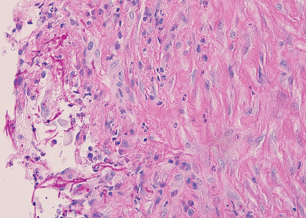 Soft tissue infection with Diaporthe phaseolorum in a 46-year-old man from Samoa, resident in New Zealand, who was a heart transplant recipient with end-stage renal failure. Histological examination of a cystic lesion over the proximal medial tibia showed reactive fibroblastic proliferation and numerous long-branching fungal septate hyphae of uneven widths. Periodic acid–Schiff staining; original magnification ×40. Photograph provided by Frederica Loghides, Department of Anatomic Pathology, Cant