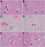 Thumbnail of Histopathological changes in formalin-fixed brain tissue of a Shuni virus PCR-positive buffalo (MVA73/10) in South Africa that showed neurologic signs (original magnification 1000×). A, B) Cerebral white matter micro/astrogliosis and cytogenic edema (arrows). C, D) Glial (suspected oligodendroglia) apoptosis (arrows). E, F) Perineural hypereosinophilic bodies (arrows); perivascular and neuropil hemorrhage (circle); single-cell neuronal degeneration (chromatolysis) (star). 