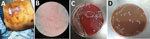 Thumbnail of Chest wound of a 64-year-old male fisherman and isolated bacteria morphology, China. A) Ulcer and necrosis in the lower chest. B) Gram-negative cocci isolated from blood and wound. C) Growth on blood agar after 5 days with CO2. D) Growth on chocolate agar after 5 days with CO2.