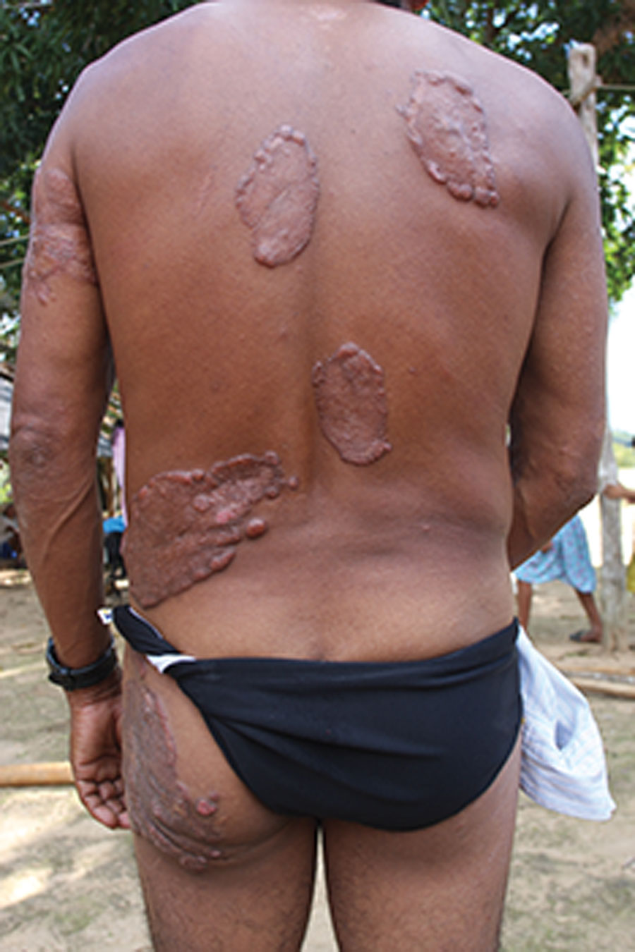 Multicentric lobomycosis affecting the back, buttocks, and arm of a Kaiabi man, Brazil.