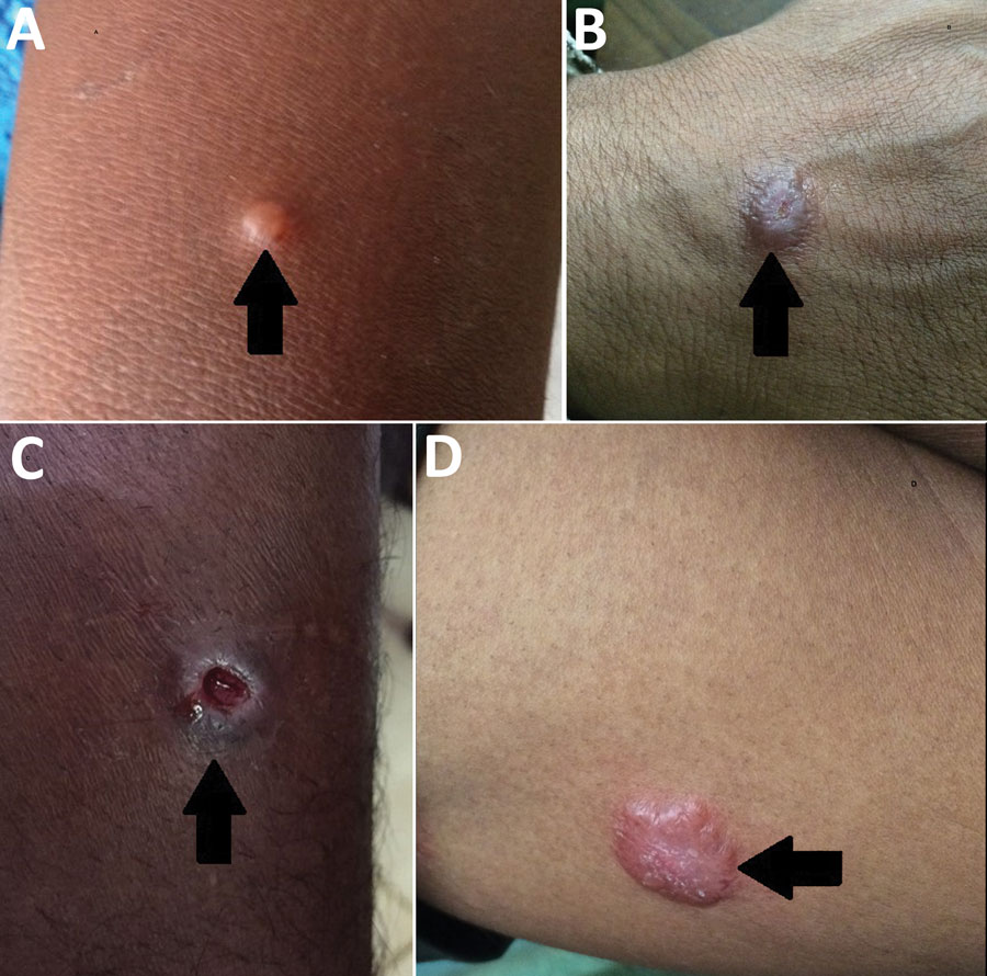 Types of skin lesions observed in cutaneous leishmaniasis case-patients, Sri Lanka, 2001–2018. Arrows indicate A) papule; B) nodule; C) ulcer; D) plaque.