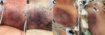 Thumbnail of Progressive changes in a cutaneous chest wound for a 63-year-old man who had melioidosis, Texas, USA, 2018. Images were obtained on A) day 3, B) day 4, C) day 9, and D) day 10 after his initial visit to hospital A on November 17, 2018.