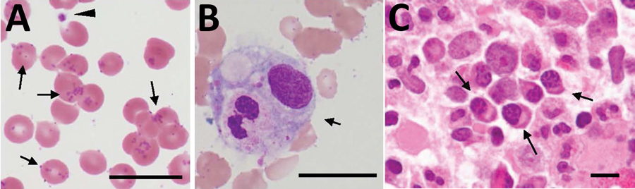 Distribution of Candidatus Mycoplasma haemohominis in a 42-year-old man, Japan. A) Peripheral blood smear showing coccoid forms. Small basophilic bodies are present on the surface of and outside erythrocytes (arrows). Arrowhead indicates a platelet. Giemsa stained. B) Hemophagocytosis (arrow) in bone marrow aspirate. Giemsa stained. C) Bone marrow biopsy specimen showing infiltration of plasma cells (arrows). Hematoxylin and eosin stained. Scale bars indicate 20 μm.